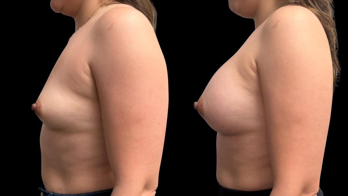Breast Augmentation Before & After Gallery - Patient 189269 - Image 5