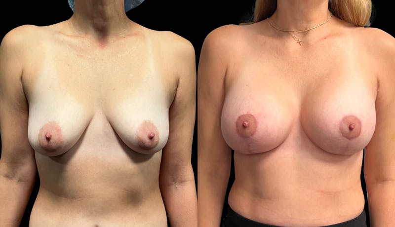 Breast Augmentation with Lift Before & After Gallery - Patient 285556 - Image 1
