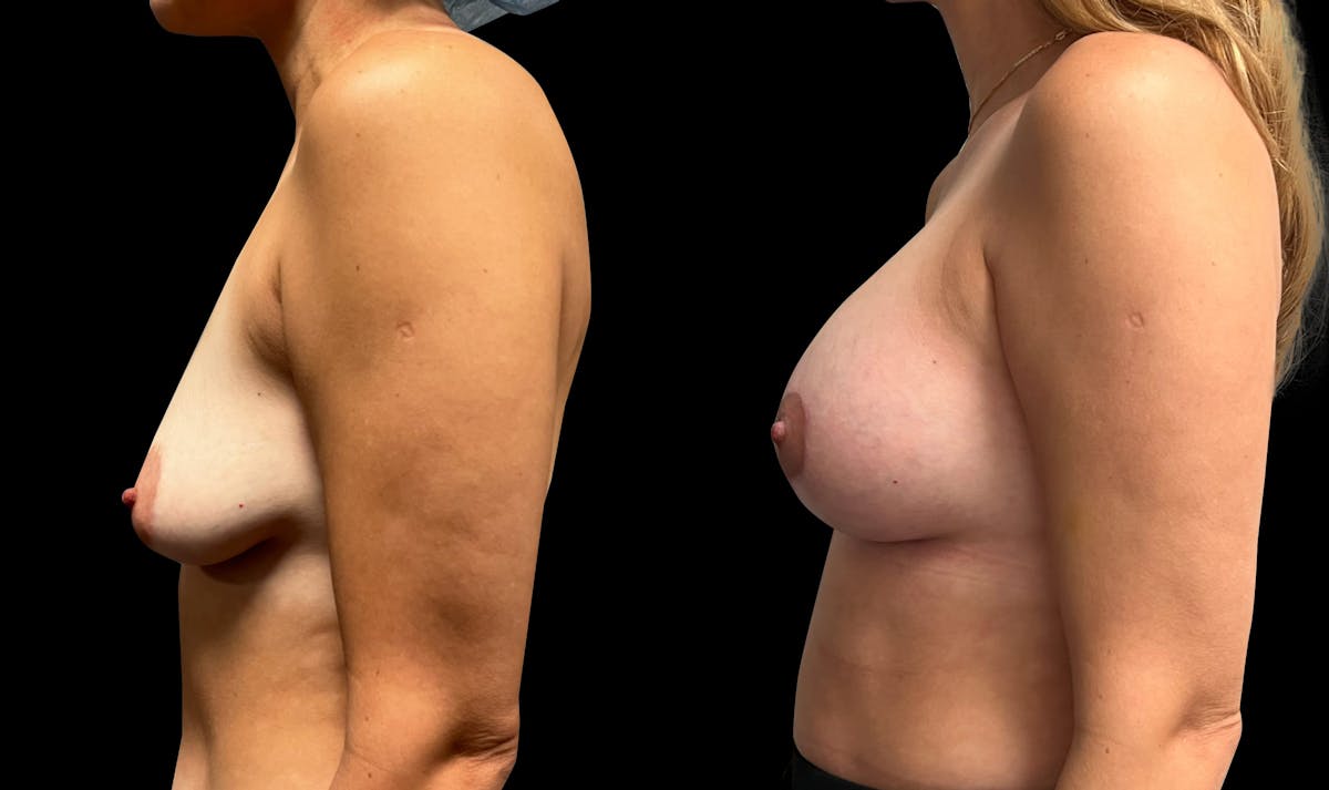 Breast Augmentation with Lift Before & After Gallery - Patient 285556 - Image 5