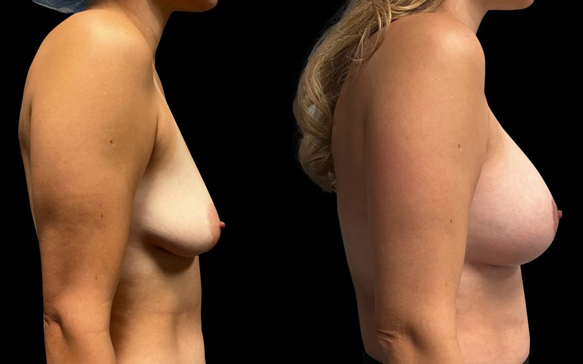Breast Augmentation with Lift Before & After Gallery - Patient 285556 - Image 3