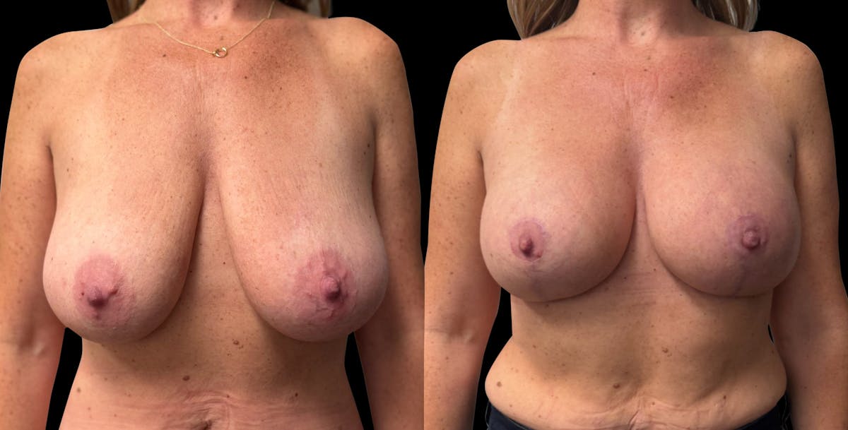 Breast Augmentation with Lift Before & After Gallery - Patient 352070 - Image 1