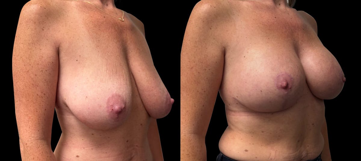 Breast Augmentation with Lift Before & After Gallery - Patient 352070 - Image 2