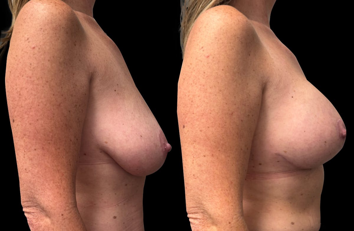 Breast Augmentation with Lift Before & After Gallery - Patient 352070 - Image 3