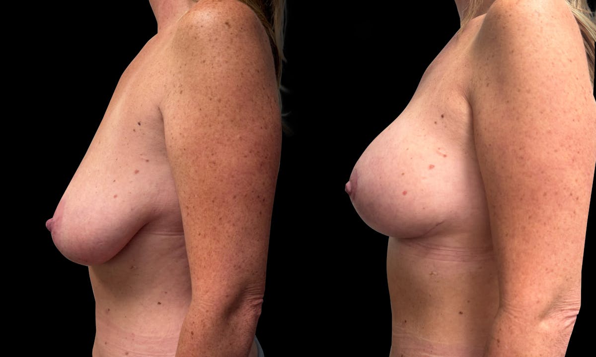 Breast Augmentation with Lift Before & After Gallery - Patient 352070 - Image 5
