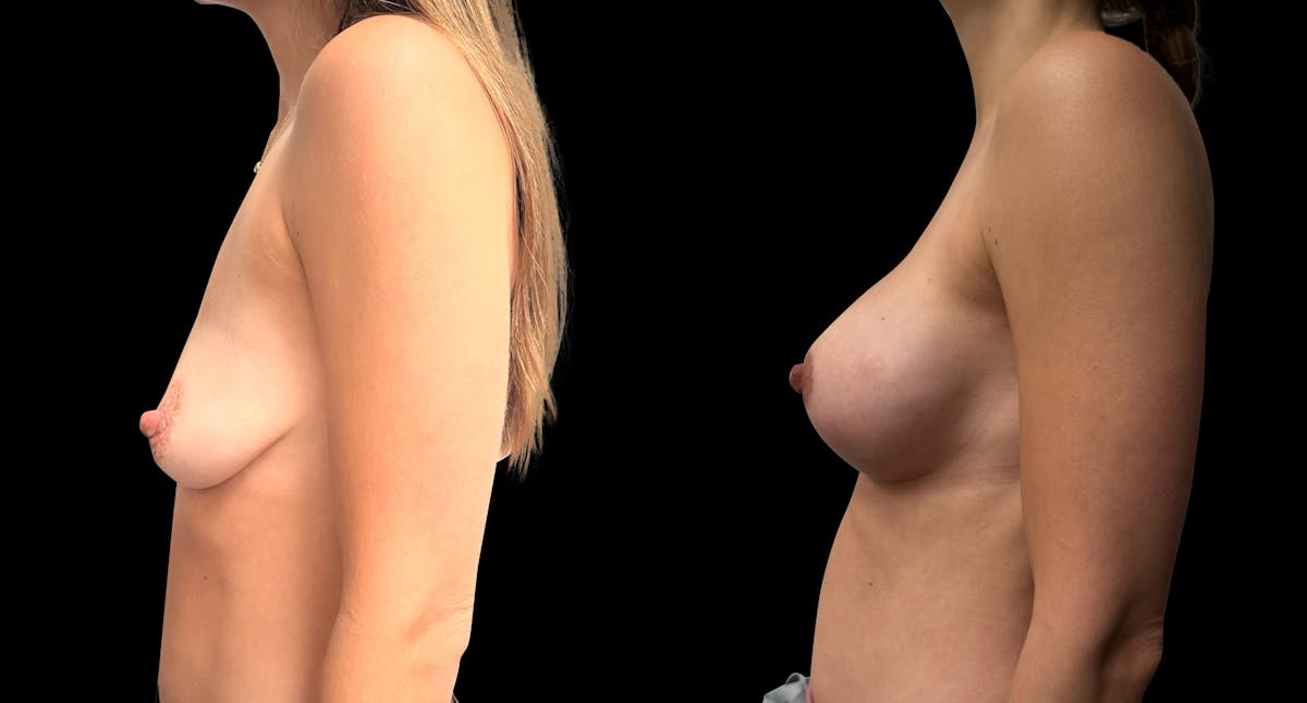 Breast Augmentation with Lift Before & After Gallery - Patient 387945 - Image 5