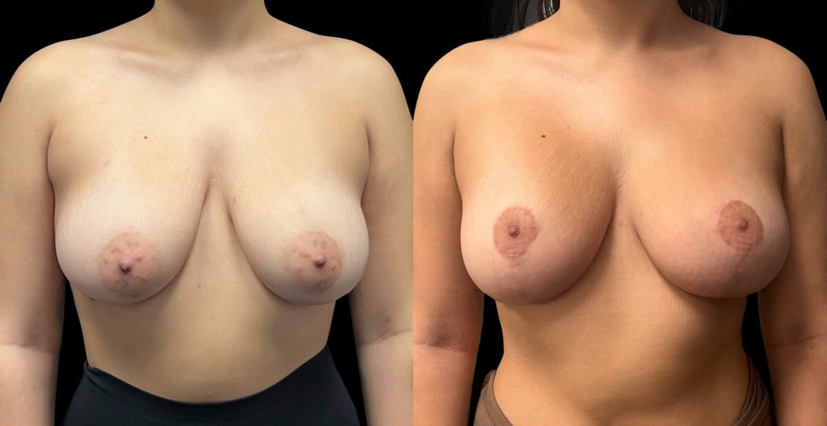 Breast Augmentation with Lift Before & After Gallery - Patient 391710 - Image 1