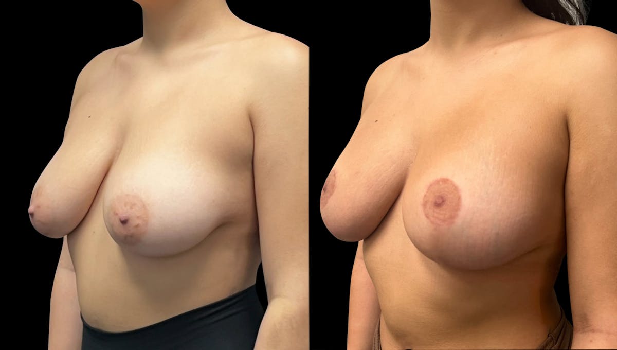 Breast Augmentation with Lift Before & After Gallery - Patient 391710 - Image 2