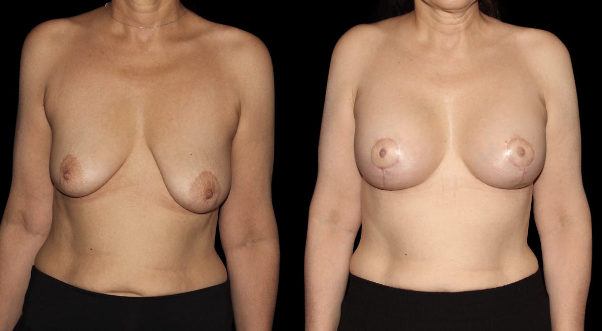 Breast Augmentation with Lift Before & After Gallery - Patient 960323 - Image 1