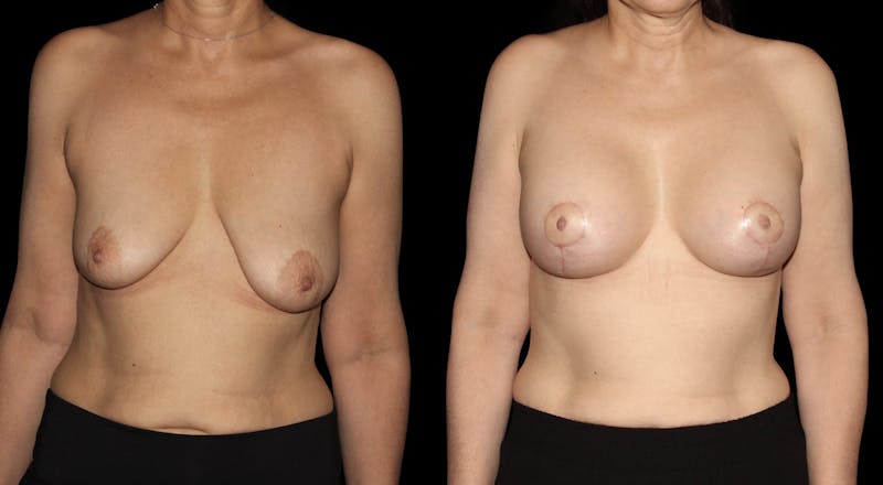 Breast Augmentation with Lift Before & After Gallery - Patient 960323 - Image 1