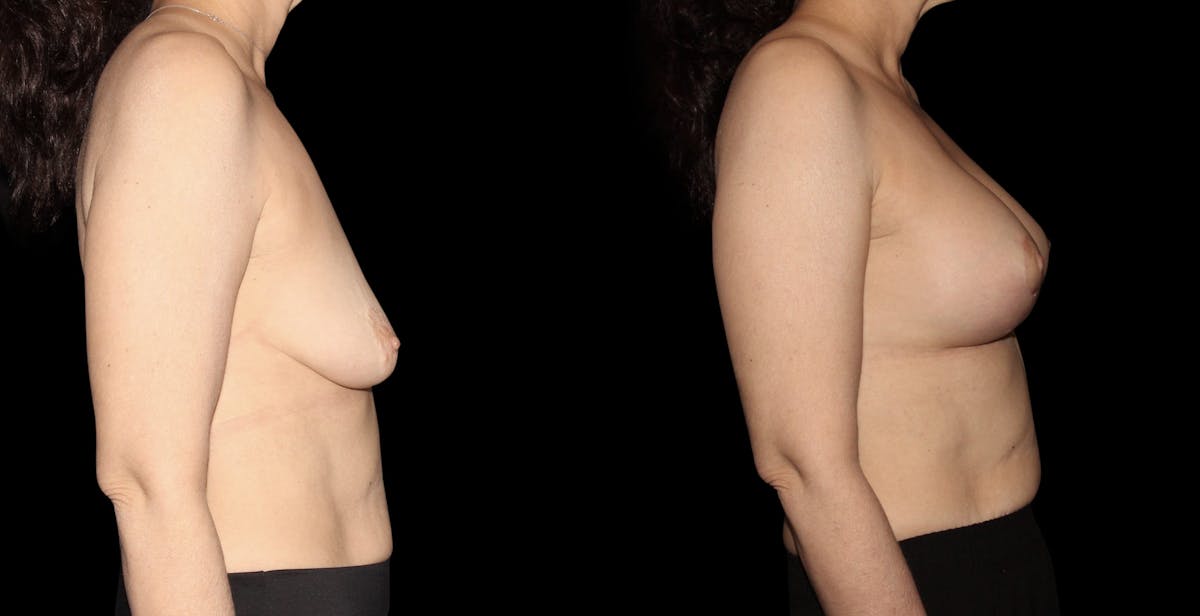 Breast Augmentation with Lift Before & After Gallery - Patient 960323 - Image 3
