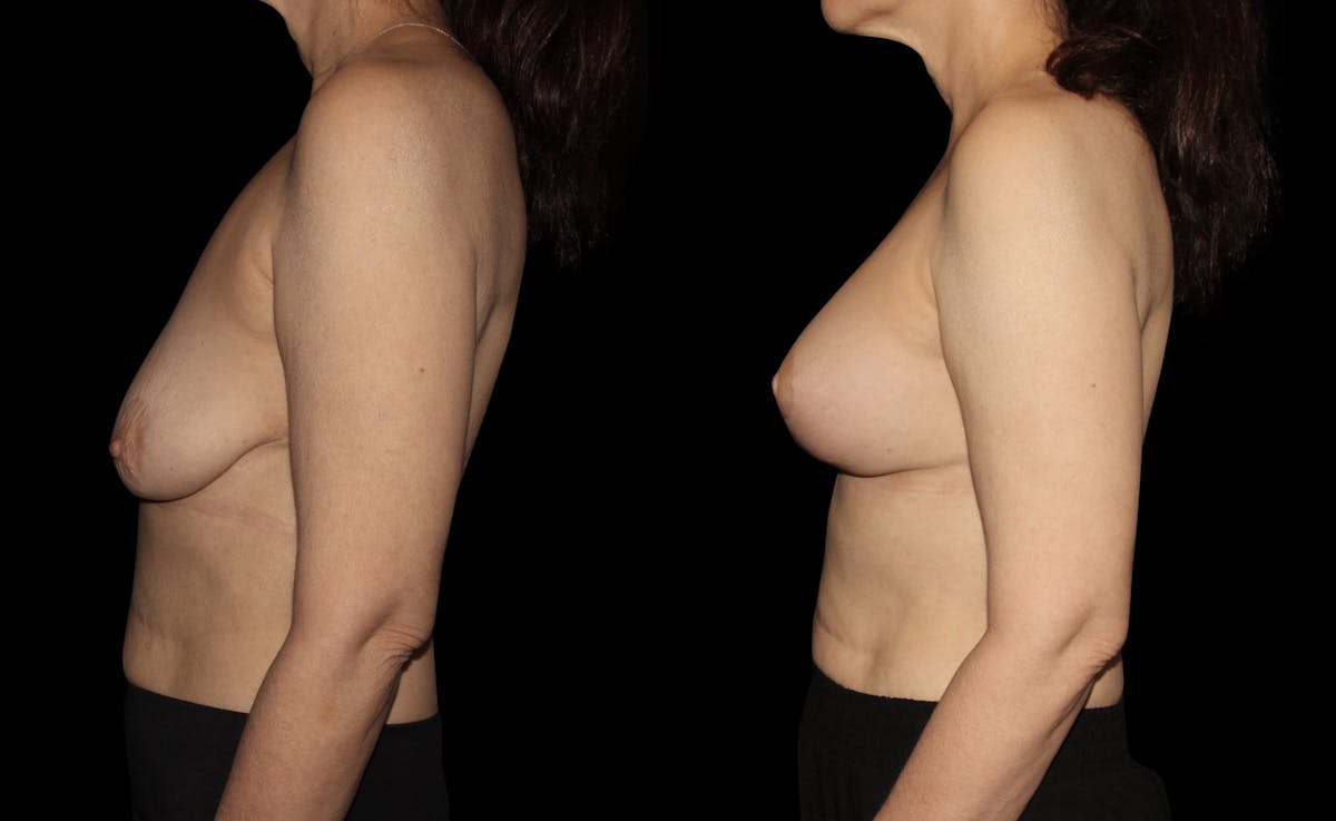 Breast Augmentation with Lift Before & After Gallery - Patient 960323 - Image 5