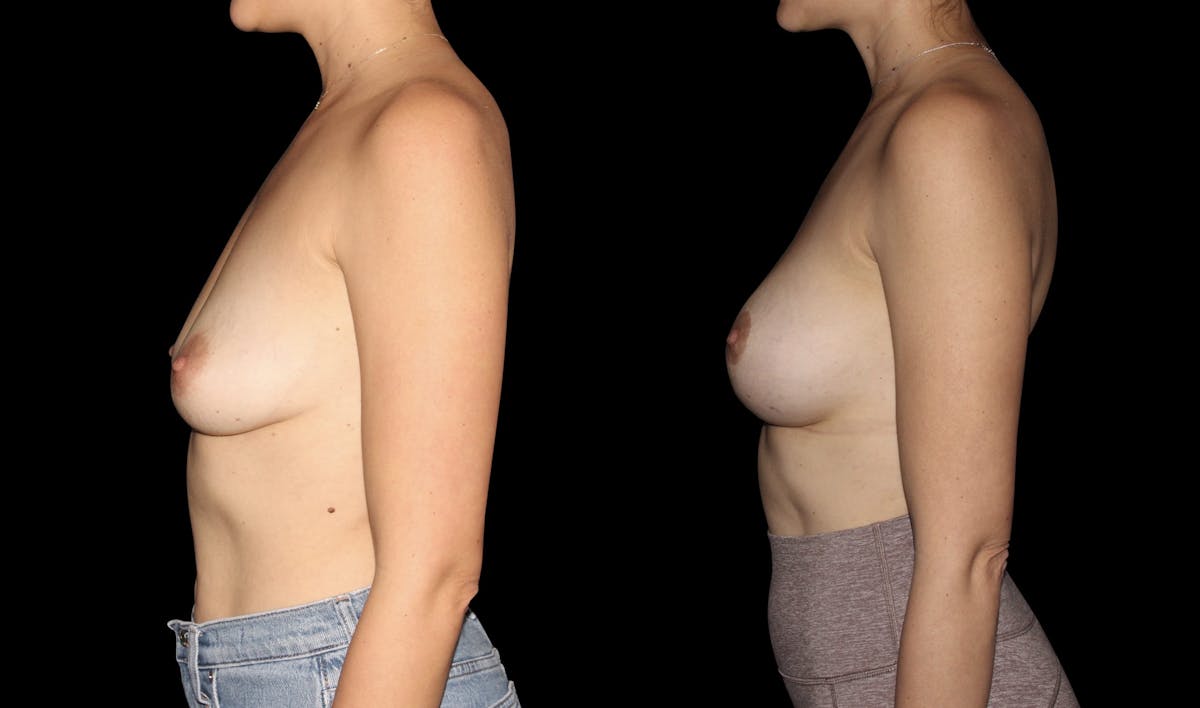 Breast Augmentation with Lift Before & After Gallery - Patient 232528 - Image 5