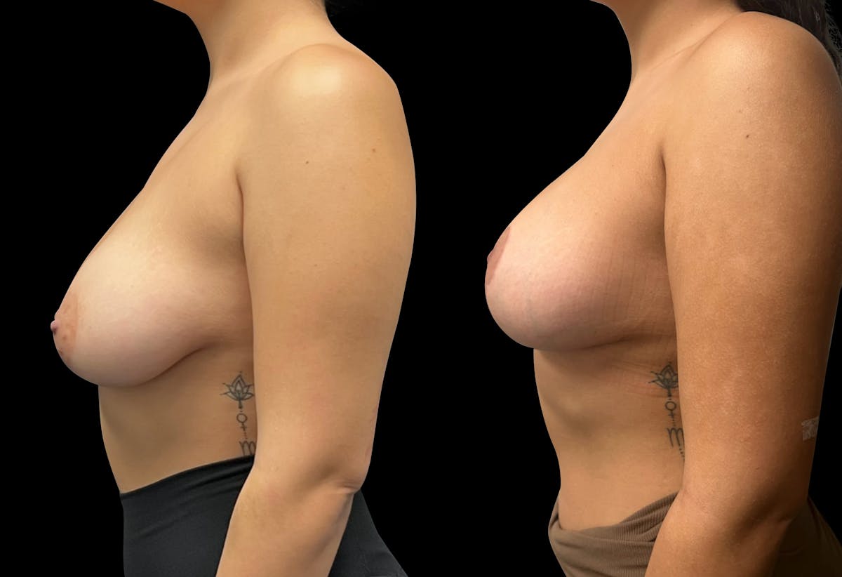Breast Augmentation with Lift Before & After Gallery - Patient 384510 - Image 3