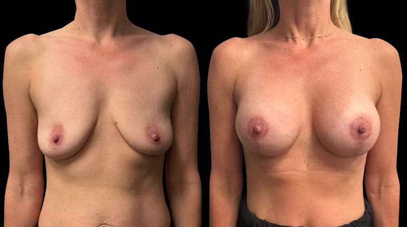 Breast Augmentation with Lift Before & After Gallery - Patient 429484 - Image 1