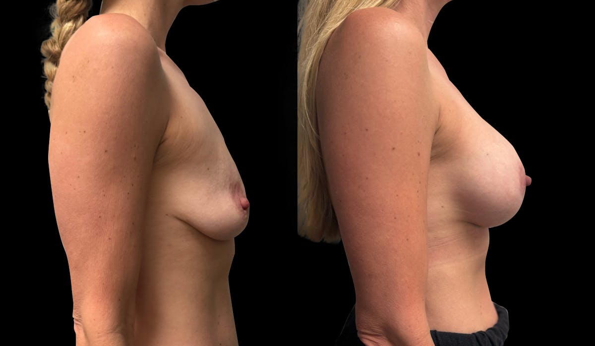 Breast Augmentation with Lift Before & After Gallery - Patient 429484 - Image 3