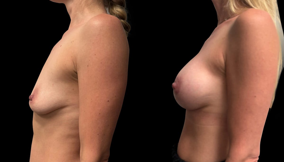 Breast Augmentation with Lift Before & After Gallery - Patient 429484 - Image 5