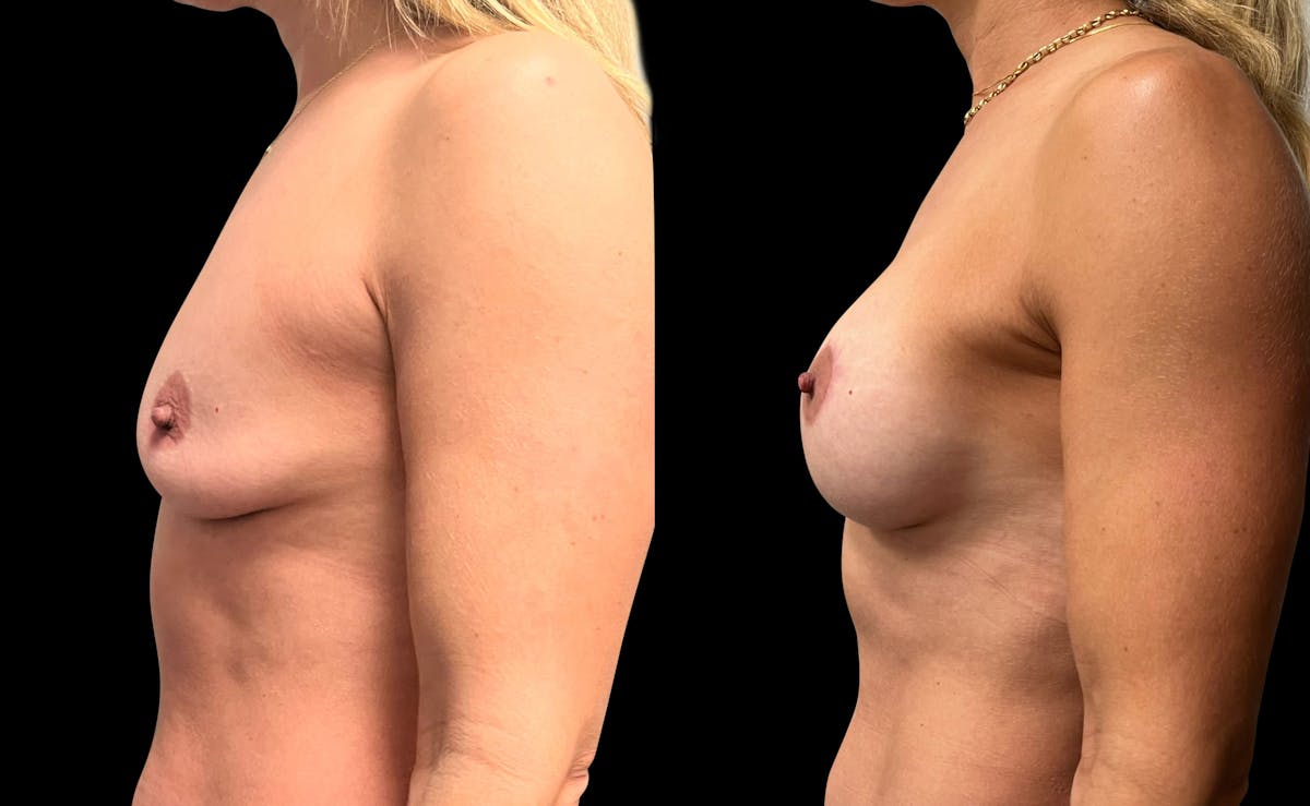 Breast Augmentation with Lift Before & After Gallery - Patient 418392 - Image 5