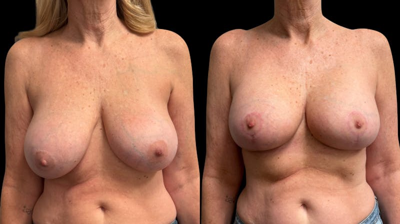 Breast Augmentation with Lift Before & After Gallery - Patient 319740 - Image 1