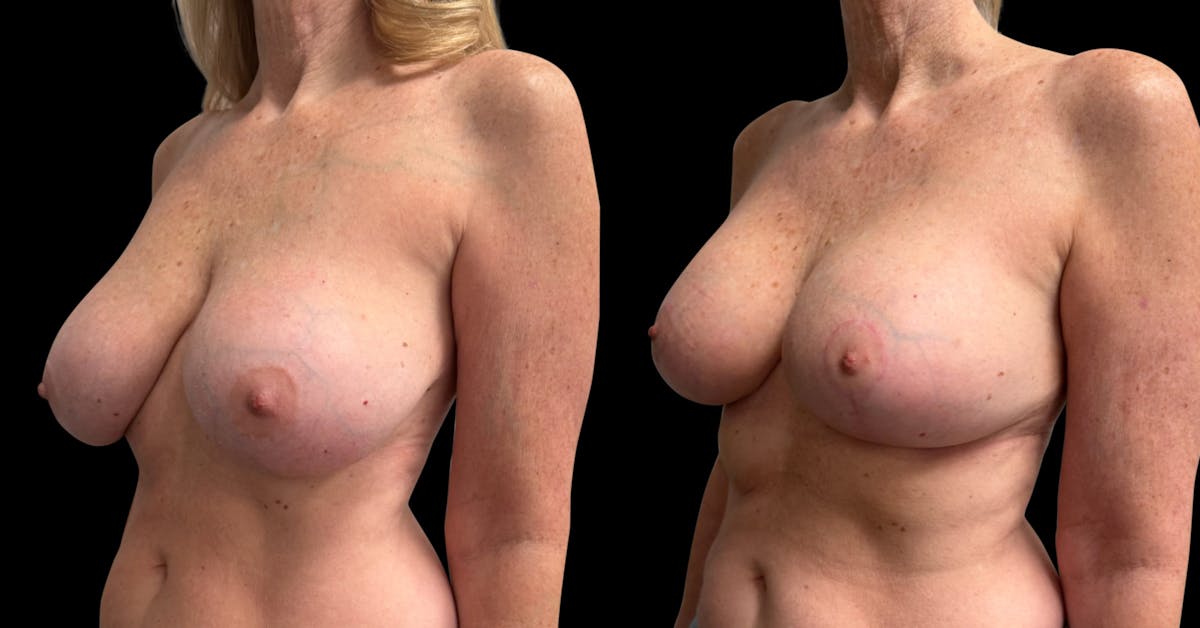 Breast Augmentation with Lift Before & After Gallery - Patient 319740 - Image 4