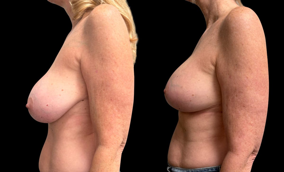 Breast Augmentation with Lift Before & After Gallery - Patient 319740 - Image 5