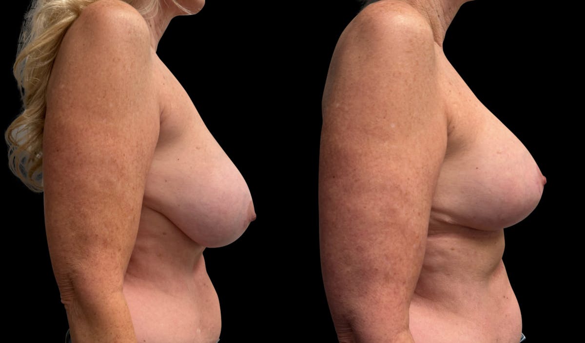 Breast Augmentation with Lift Before & After Gallery - Patient 319740 - Image 3