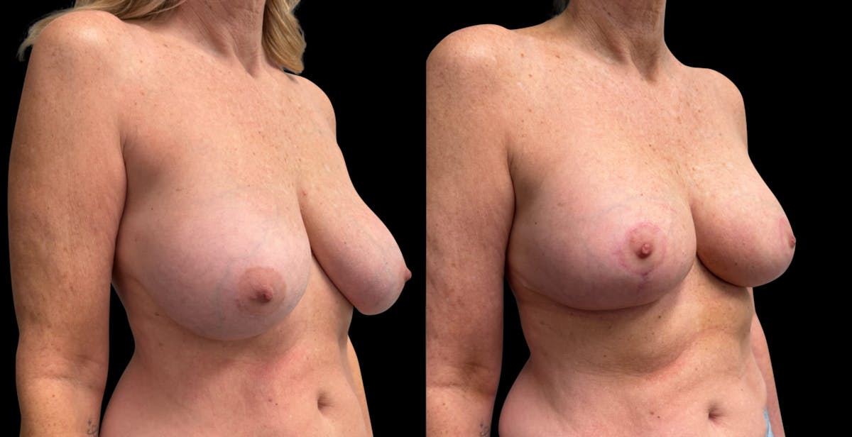 Breast Augmentation with Lift Before & After Gallery - Patient 319740 - Image 2