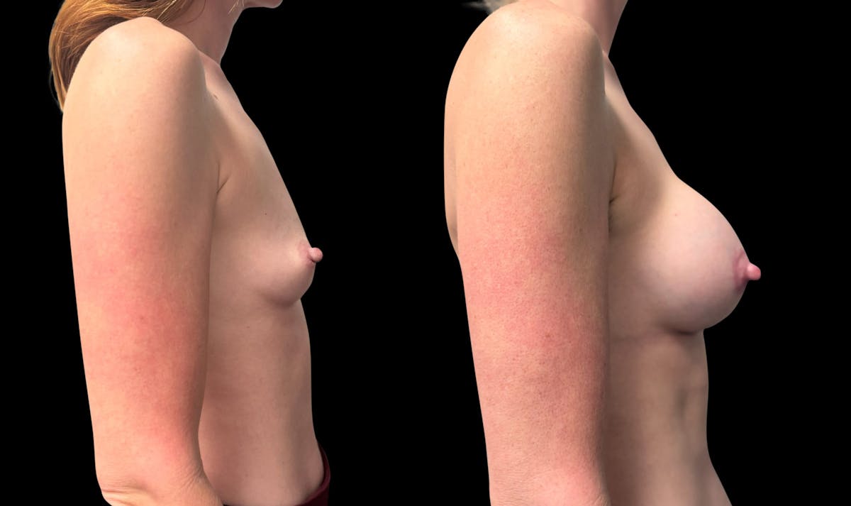 Breast Augmentation with Lift Before & After Gallery - Patient 176025 - Image 3