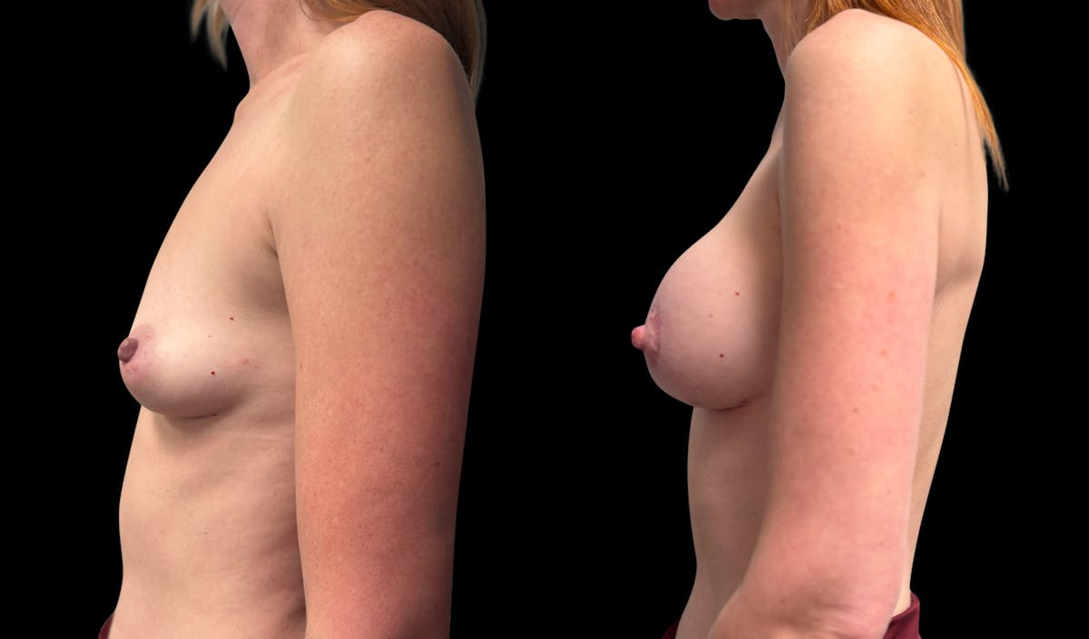 Breast Augmentation with Lift Before & After Gallery - Patient 176025 - Image 5
