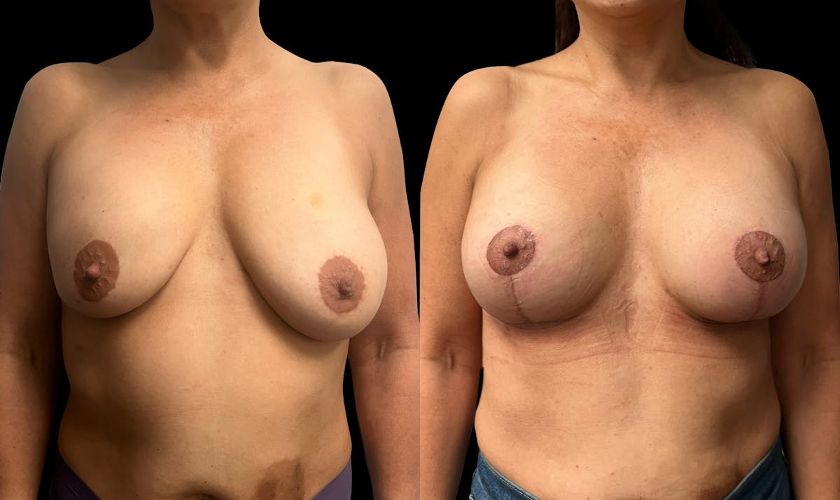Breast Augmentation with Lift Before & After Gallery - Patient 103995 - Image 1
