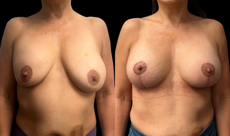 Breast Augmentation with Lift Before & After Gallery - Patient 103995 - Image 1