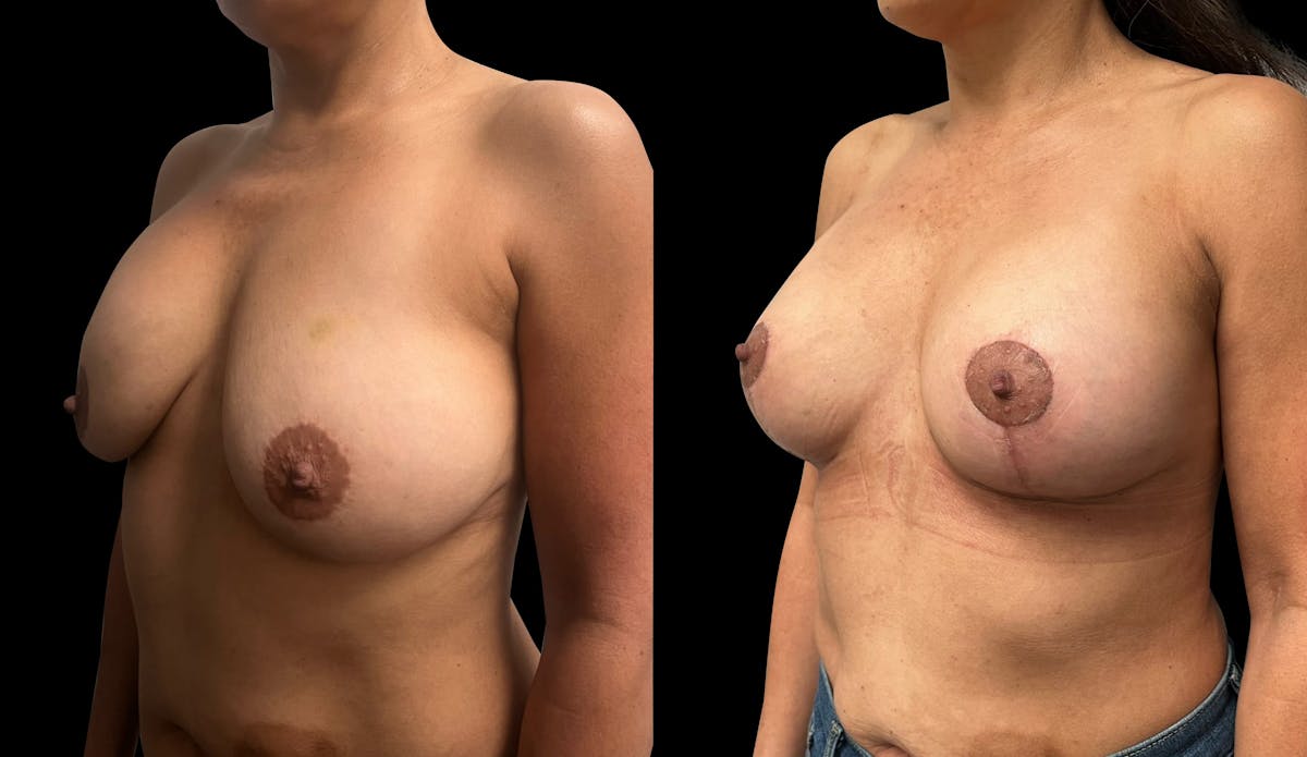 Breast Augmentation with Lift Before & After Gallery - Patient 103995 - Image 4