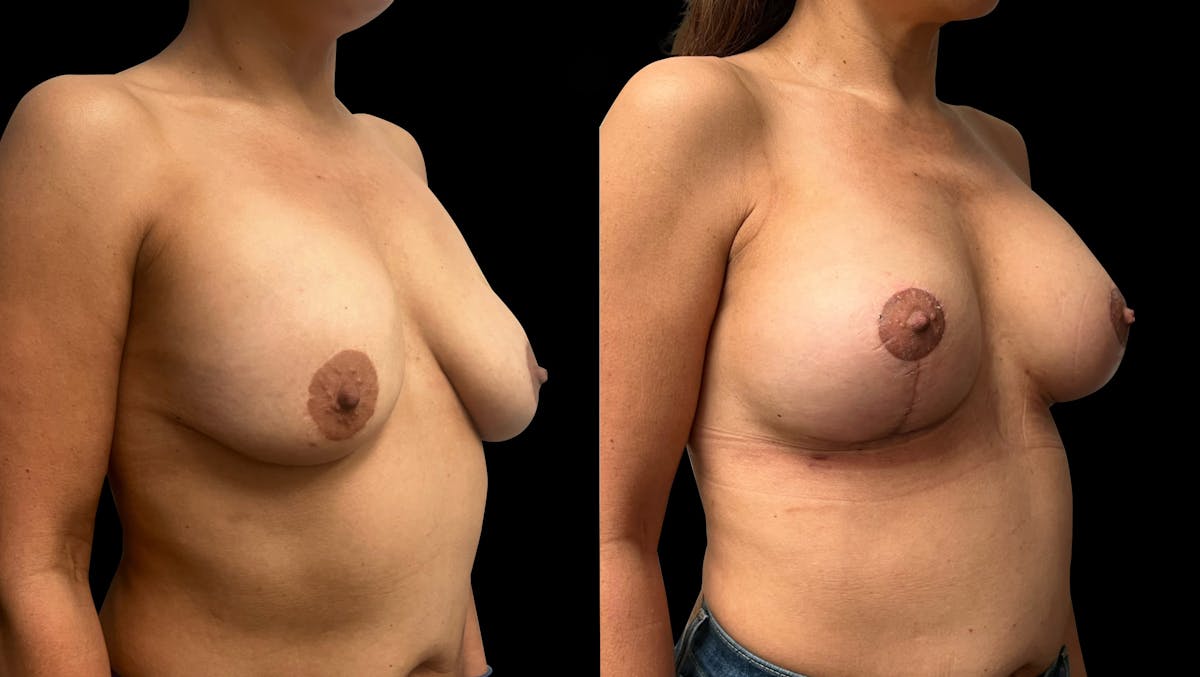 Breast Augmentation with Lift Before & After Gallery - Patient 103995 - Image 2