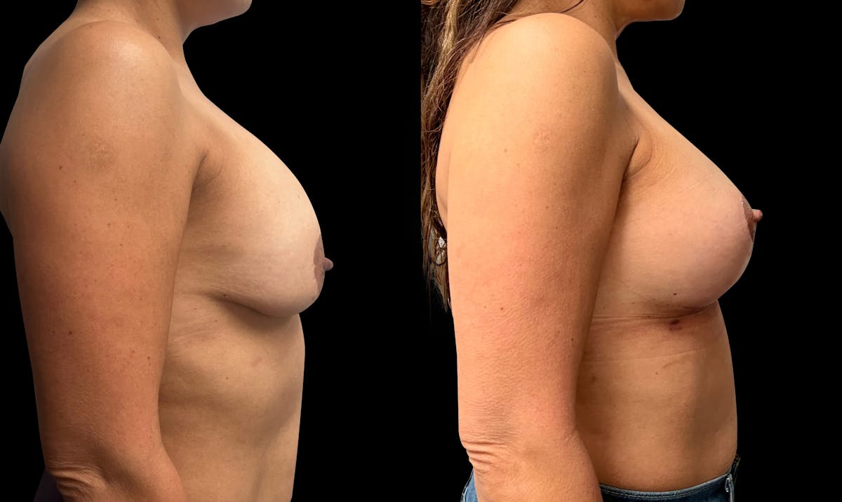 Breast Augmentation with Lift Before & After Gallery - Patient 103995 - Image 3