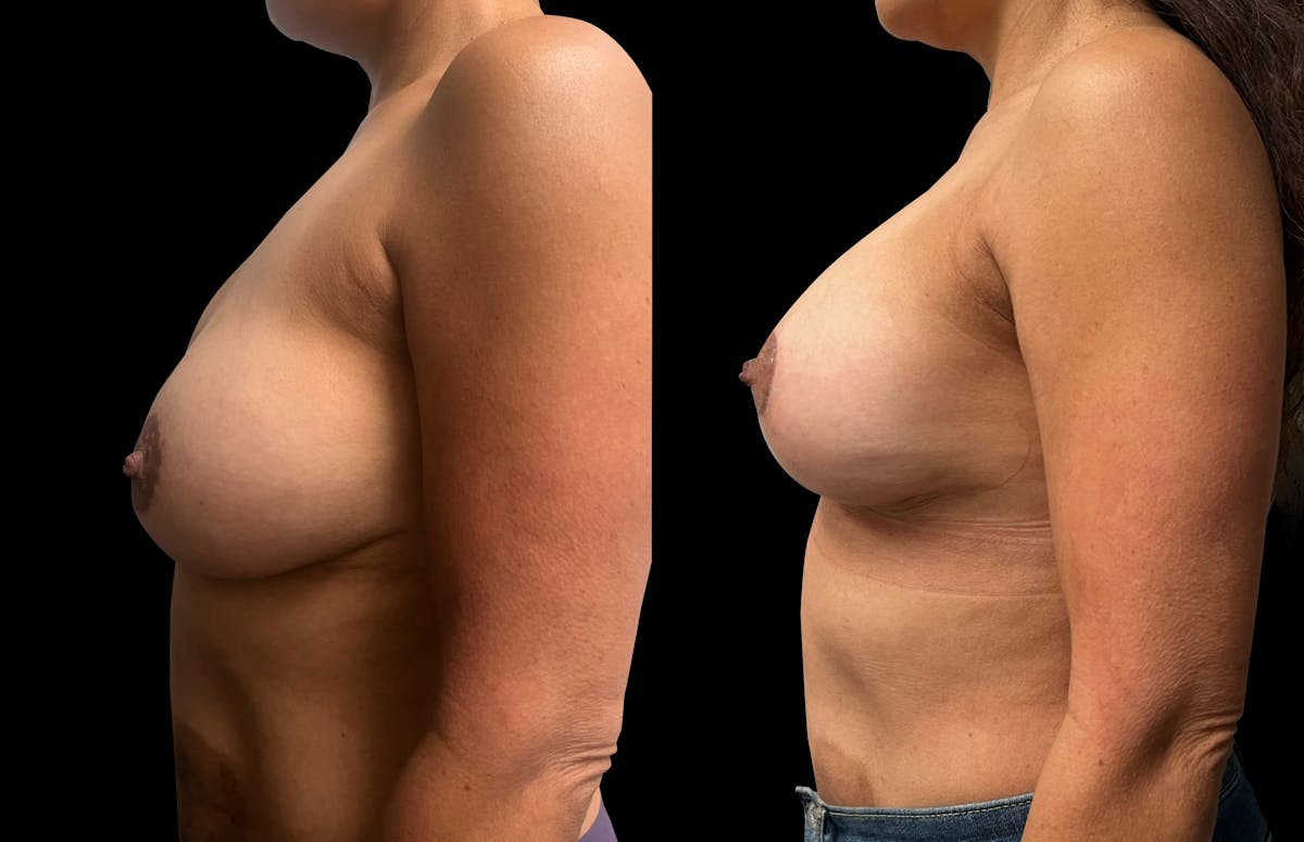 Breast Augmentation with Lift Before & After Gallery - Patient 103995 - Image 5