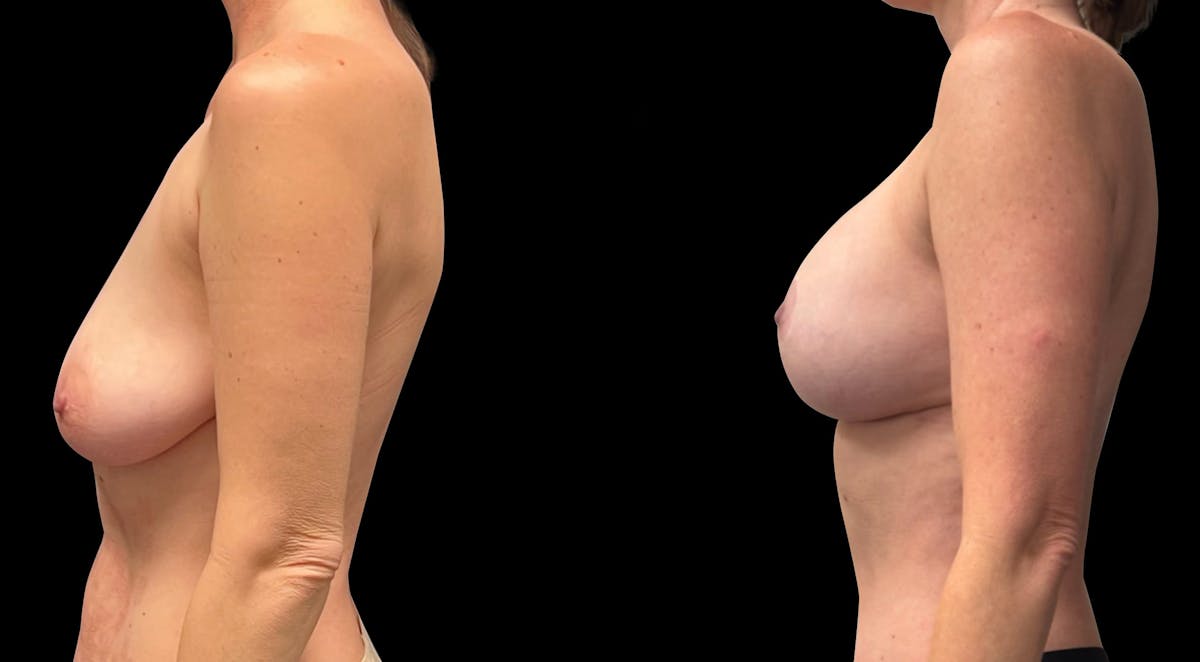 Breast Augmentation with Lift Before & After Gallery - Patient 268105 - Image 5