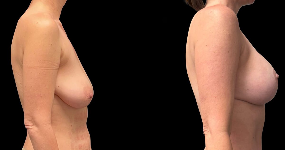 Breast Augmentation with Lift Before & After Gallery - Patient 268105 - Image 3