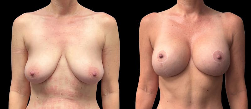 Breast Augmentation with Lift Before & After Gallery - Patient 268105 - Image 1