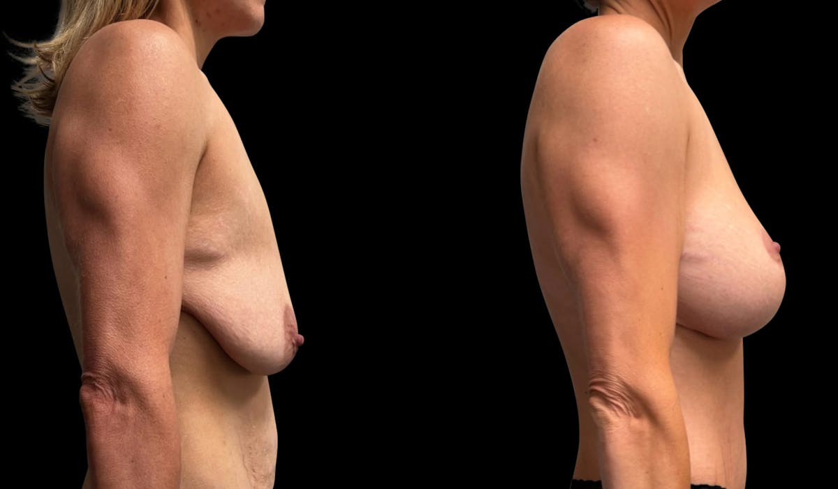 Breast Augmentation with Lift Before & After Gallery - Patient 146495 - Image 3