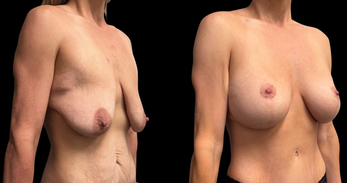 Breast Augmentation with Lift Before & After Gallery - Patient 146495 - Image 2