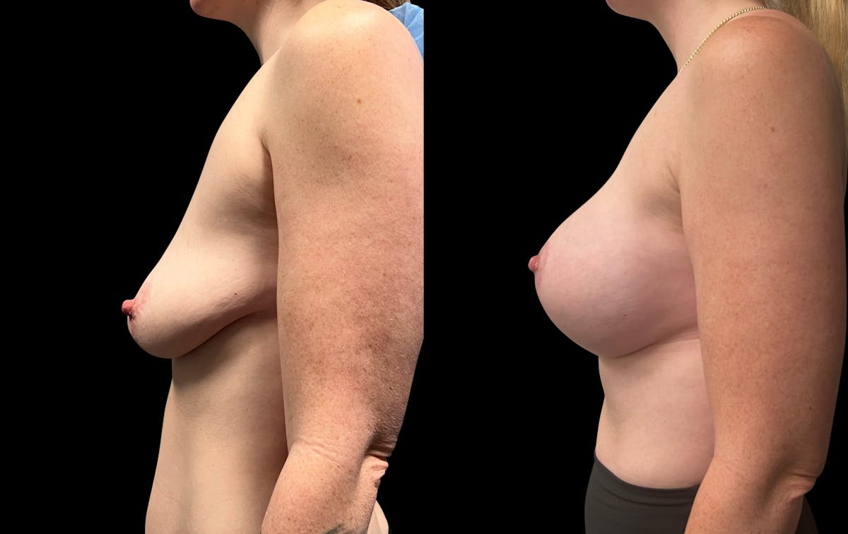 Breast Augmentation with Lift Before & After Gallery - Patient 774469 - Image 2
