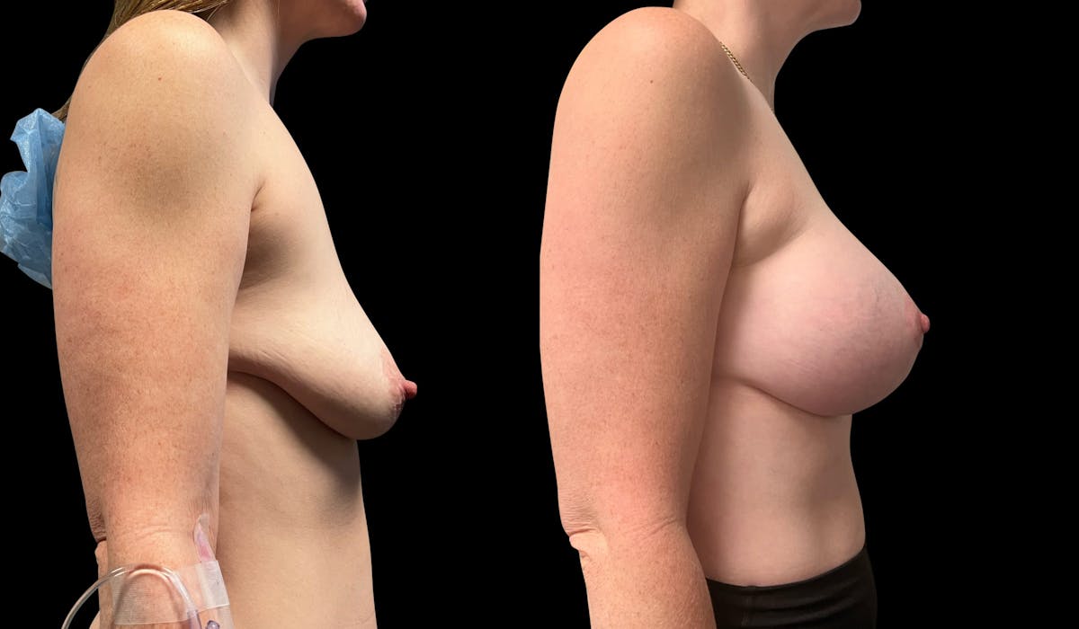 Breast Augmentation with Lift Before & After Gallery - Patient 774469 - Image 4