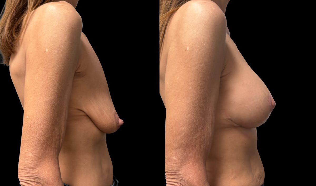Breast Augmentation with Lift Before & After Gallery - Patient 425541 - Image 3