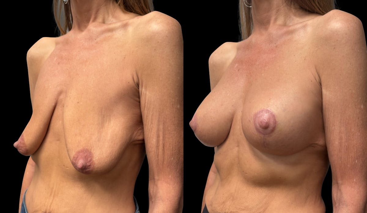 Breast Augmentation with Lift Before & After Gallery - Patient 425541 - Image 4