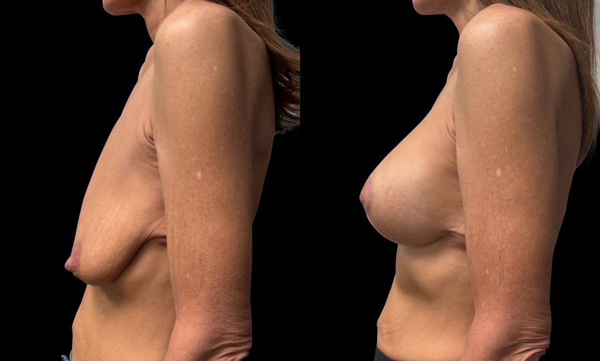 Breast Augmentation with Lift Before & After Gallery - Patient 425541 - Image 5