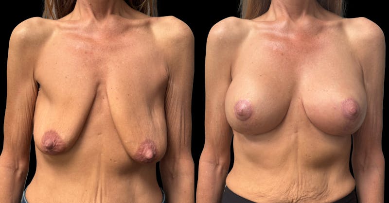 Breast Augmentation with Lift Before & After Gallery - Patient 425541 - Image 1