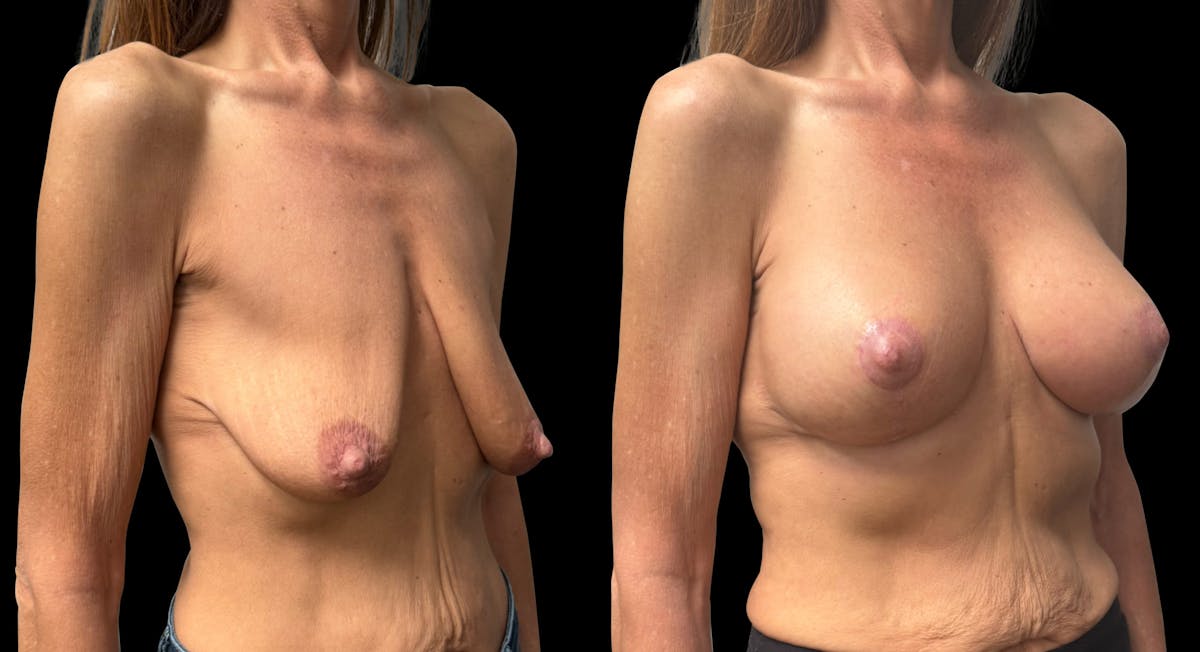 Breast Augmentation with Lift Before & After Gallery - Patient 425541 - Image 2