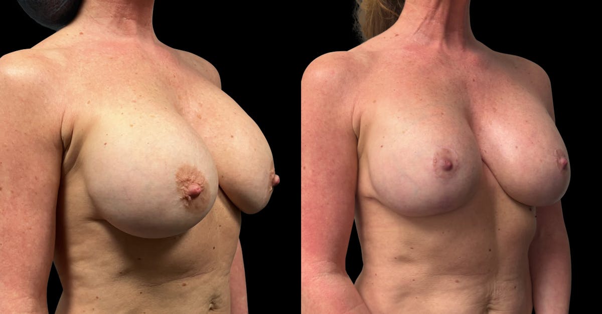 Breast Implant Exchange Before & After Gallery - Patient 259491 - Image 2