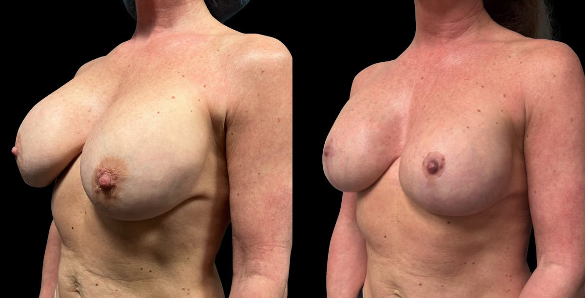 Breast Implant Exchange Before & After Gallery - Patient 259491 - Image 4