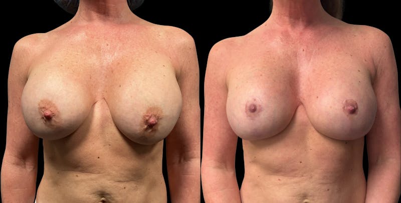 Breast Implant Exchange Before & After Gallery - Patient 259491 - Image 1