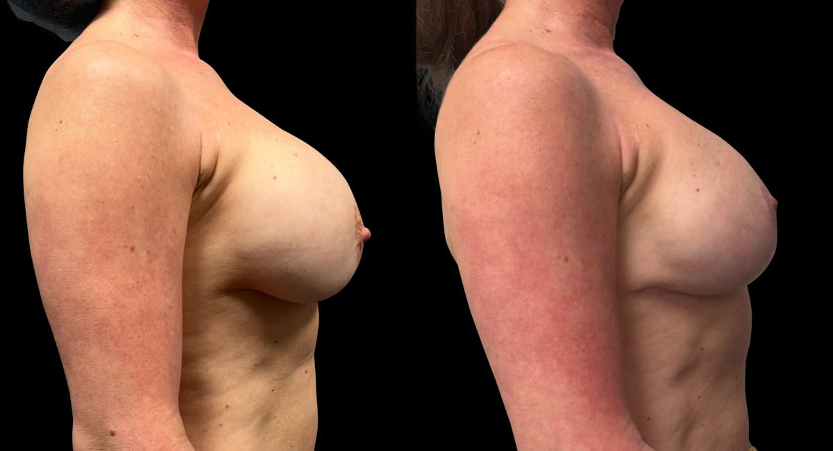 Breast Implant Exchange Before & After Gallery - Patient 259491 - Image 3